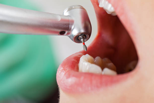 Best Emergency Wisdom Teeth Removal in Oakland, FL